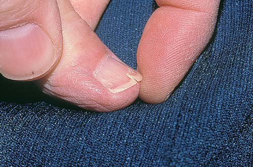 爪の健康 東洋医学の爪の診断 写真